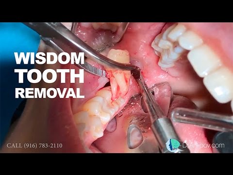 How A Wisdom Tooth Is Removed