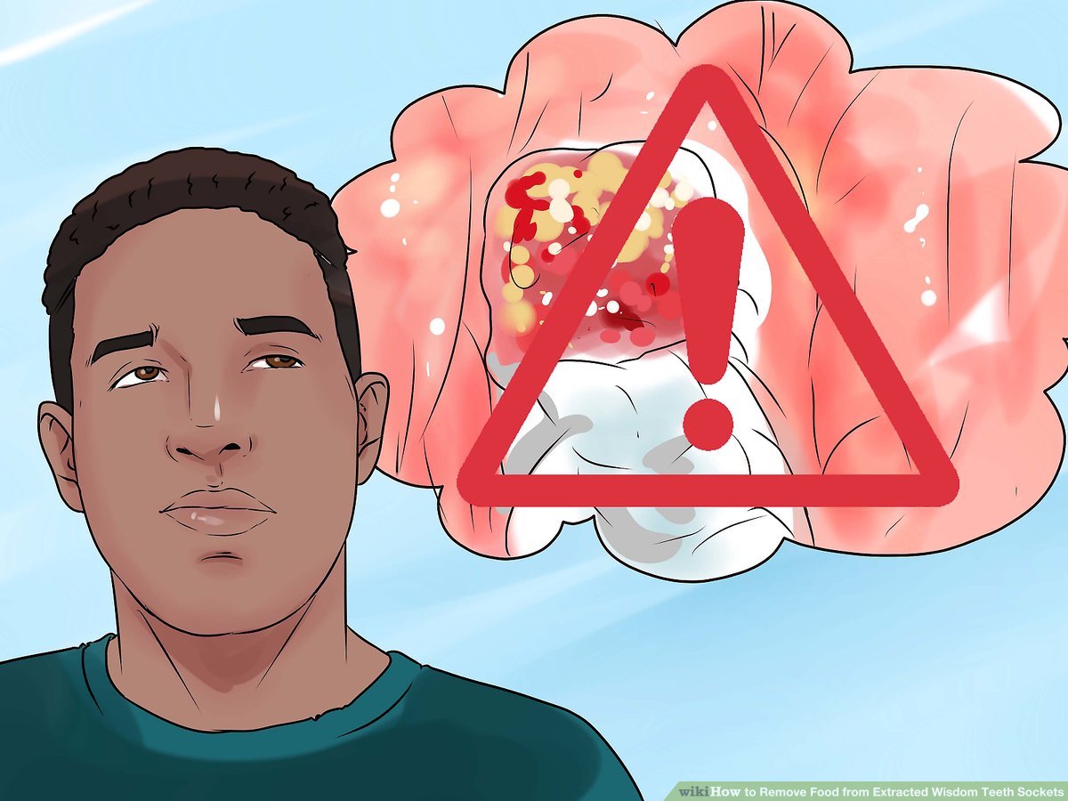 How To Get Food Out Of Wisdom Tooth Hole