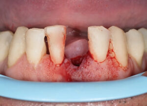 What Does a Wisdom Tooth Blood Clot Look Like