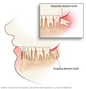 What Does an Infected Wisdom Tooth Extraction Look Like