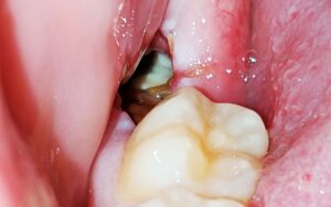 What is a Dry Socket Wisdom Tooth
