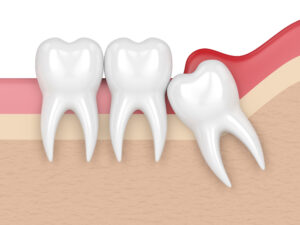 What is a Wisdom Tooth