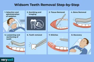 What to Do After Wisdom Tooth Removal