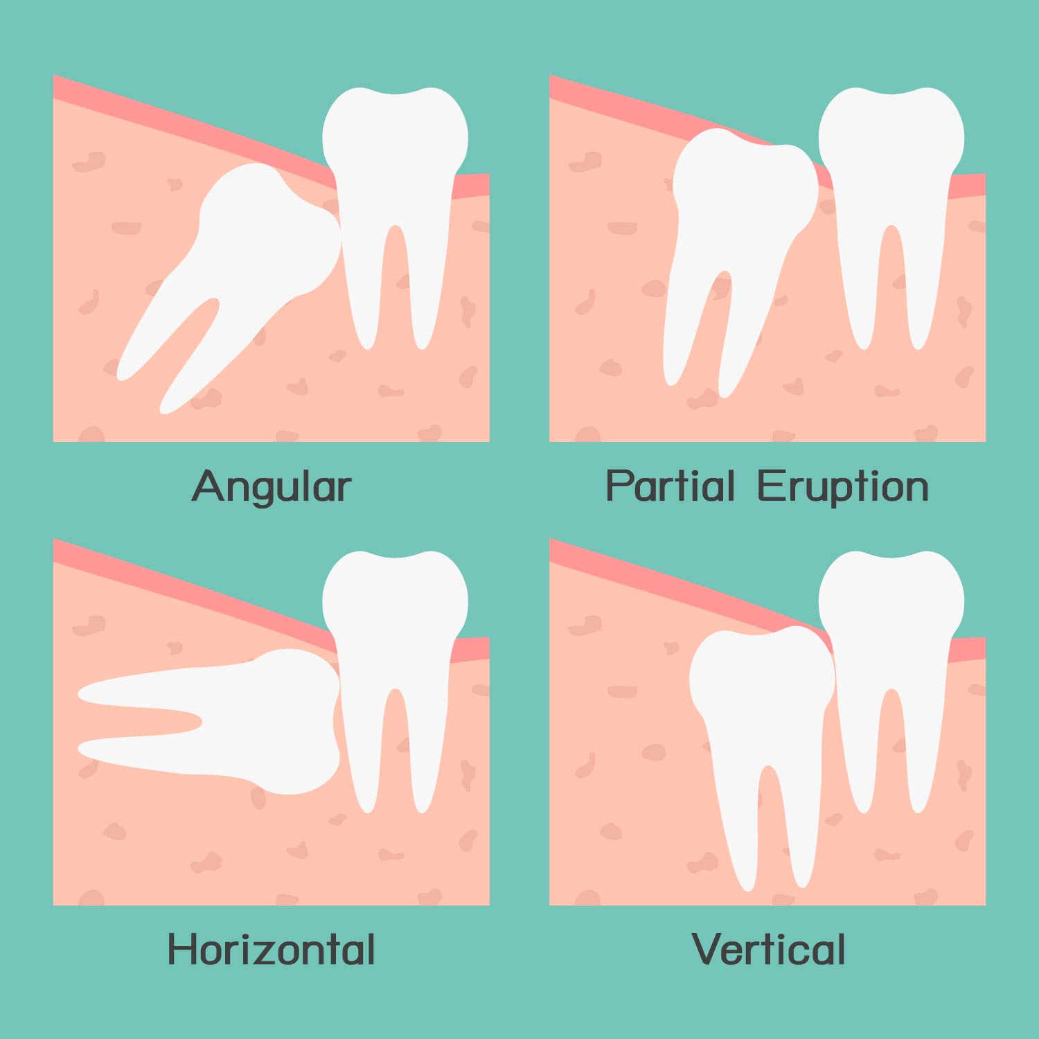 when-is-wisdom-tooth-pain-the-worst