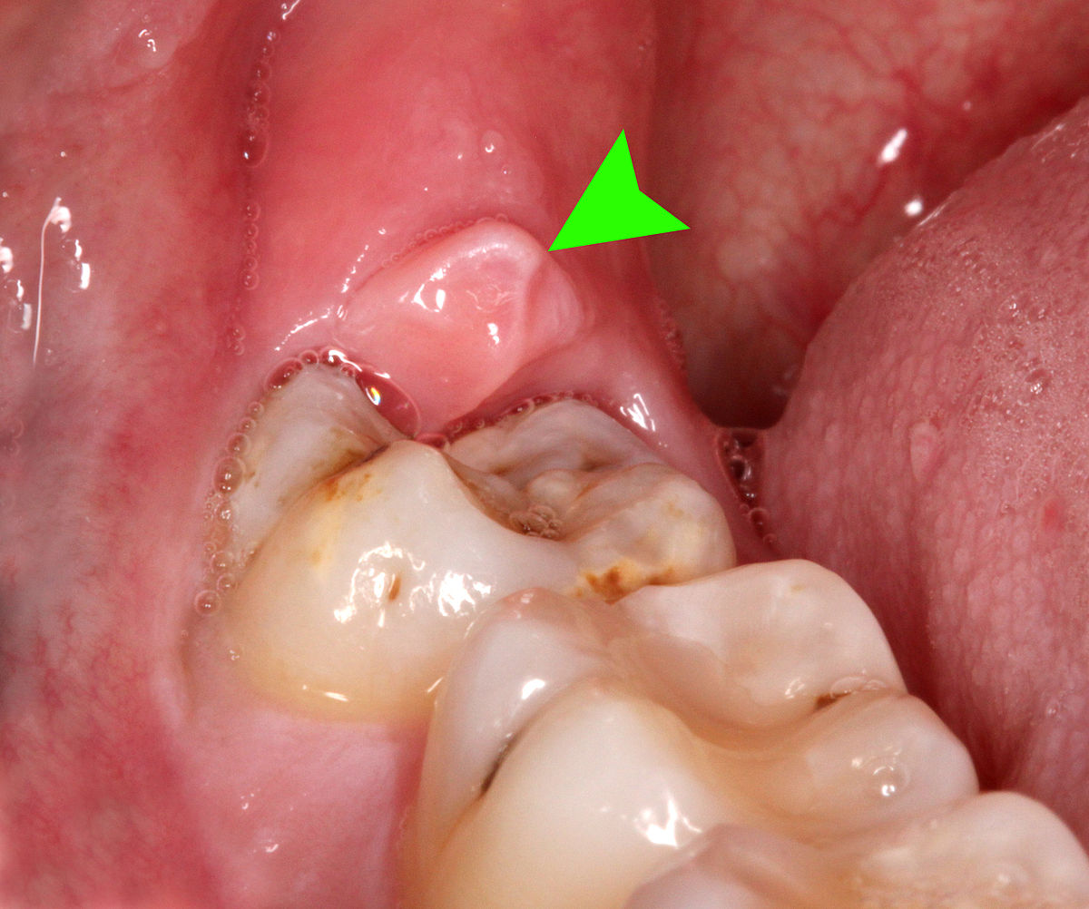 wisdom-tooth-is-infected