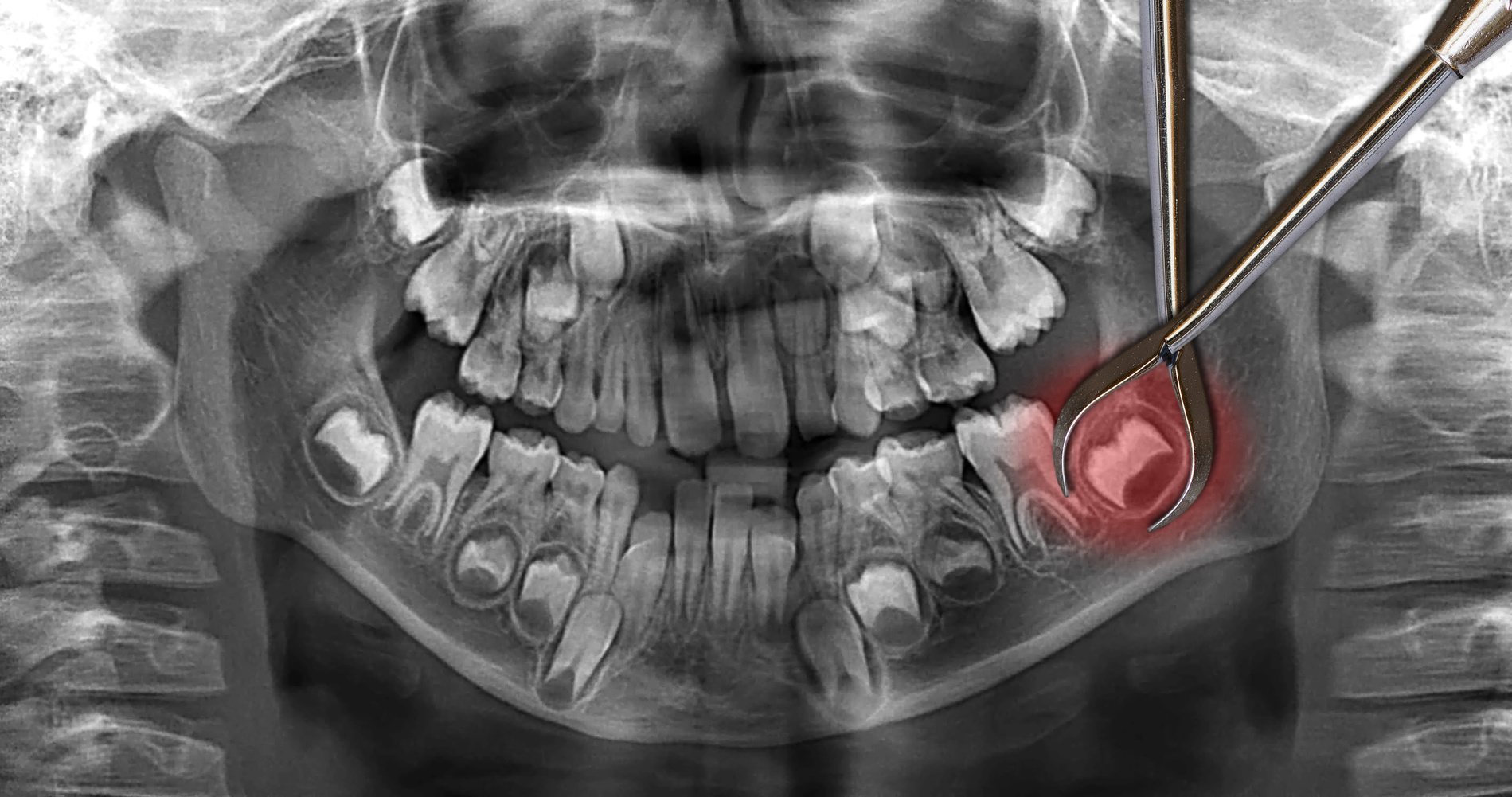 Gum Hurts Where Wisdom Tooth was Removed Years Ago