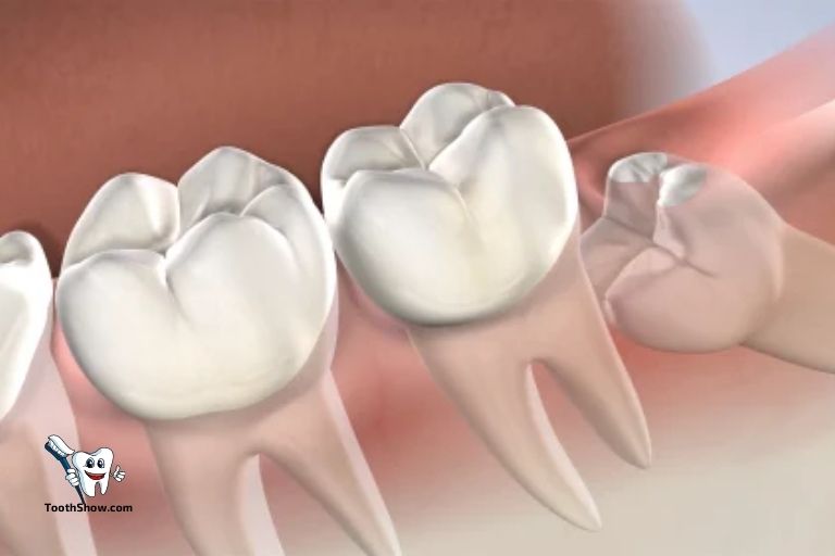 Can I Use Peroxide After Wisdom Tooth Extraction