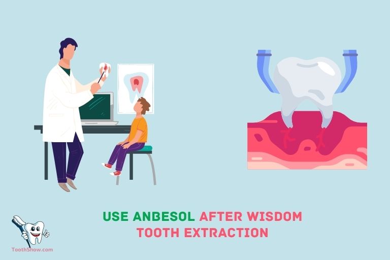 Can You Use Anbesol After Wisdom Tooth Extraction