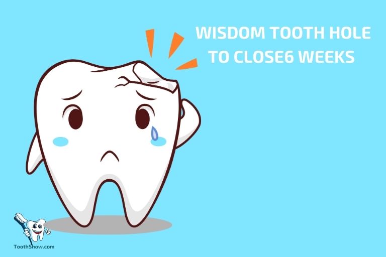 How Long For Wisdom Tooth Hole To Close