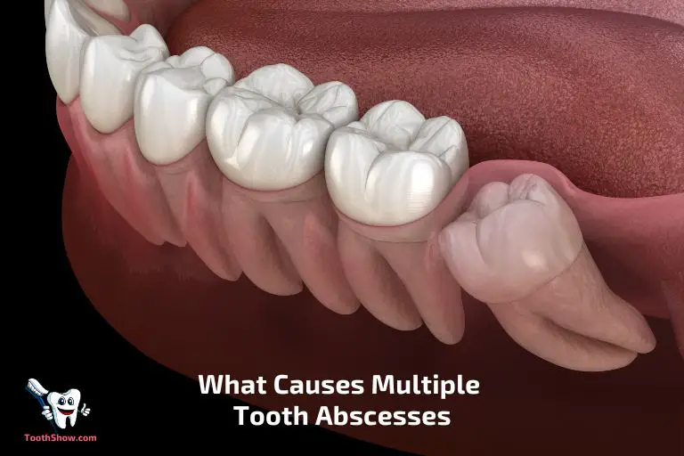What Causes Multiple Tooth Abscesses