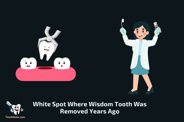 White Spot Where Wisdom Tooth Was Removed Years Ago