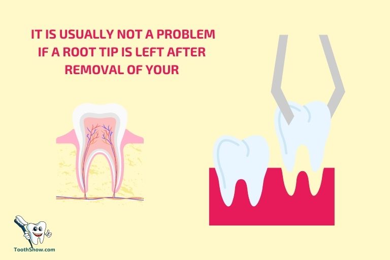 Can You Leave The Root Of A Wisdom Tooth In