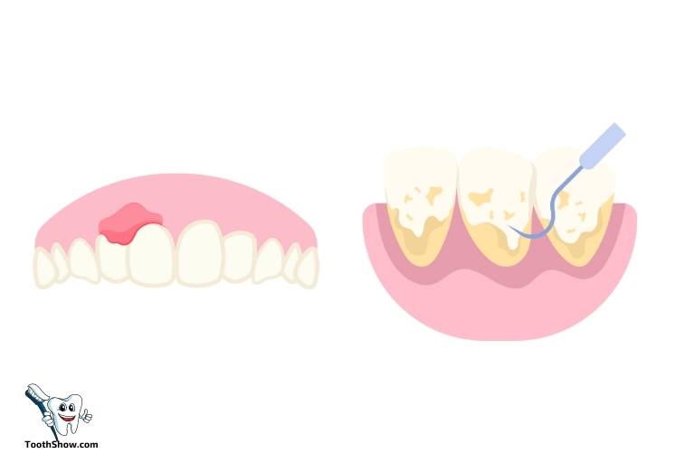 does an abscessed tooth need a root canal