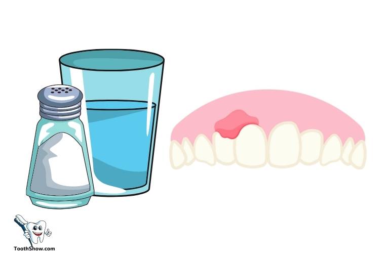 does salt water help tooth abscess
