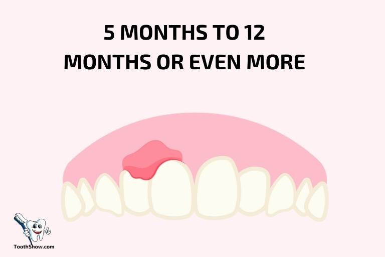 how long does an abscess tooth last