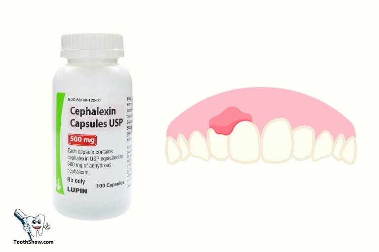 is cephalexin good for abscess tooth