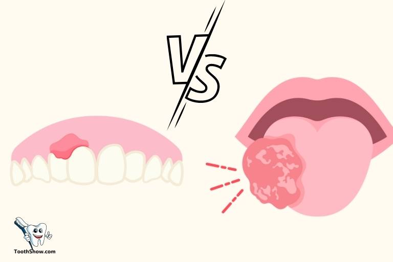 tooth abscess vs canker sore