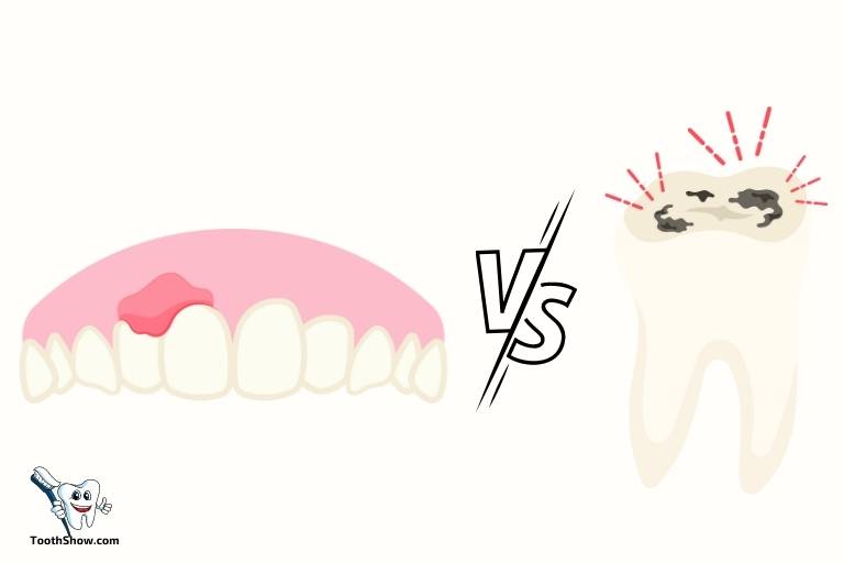 tooth abscess vs gum abscess