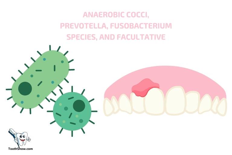 what bacteria causes tooth abscess