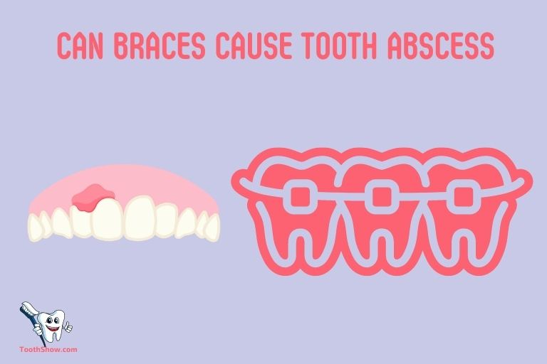 Can Braces Cause Tooth Abscess1