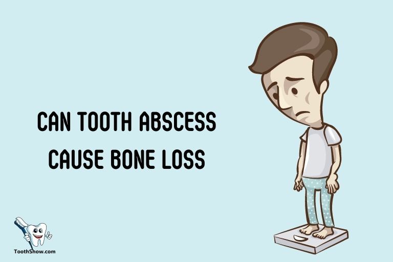 Can Tooth Abscess Cause Bone Loss