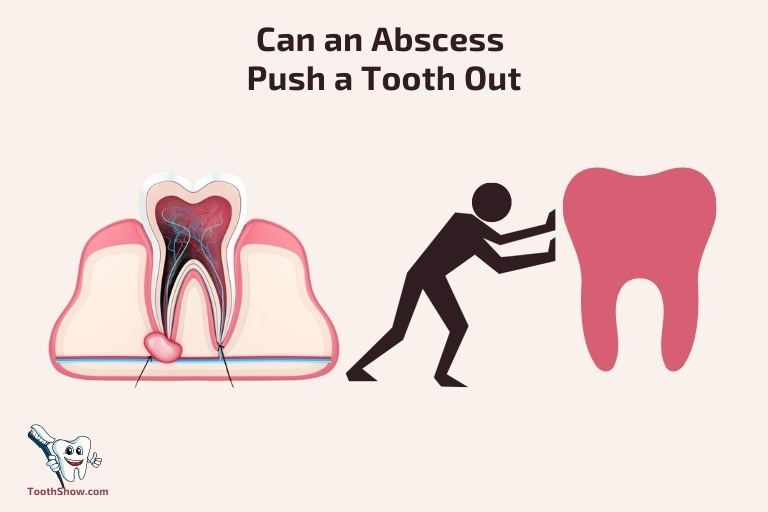 Can an Abscess Push a Tooth Out ()