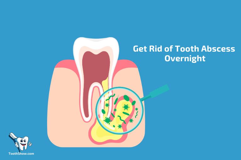 Get Rid of Tooth Abscess Overnight