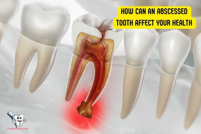 How Can an Abscessed Tooth Affect Your Health