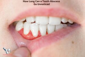How Long Can a Tooth Abscess Go Unnoticed? 4 Stages!