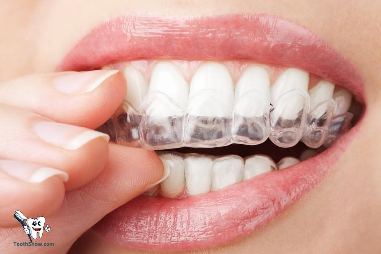 What Is the Best Teeth Whitening Method at Home