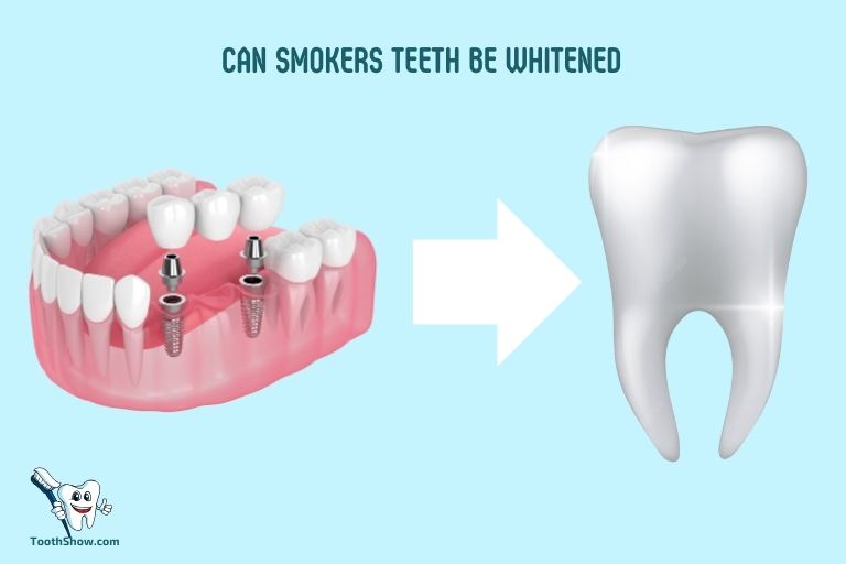 Can Smokers Teeth Be Whitened
