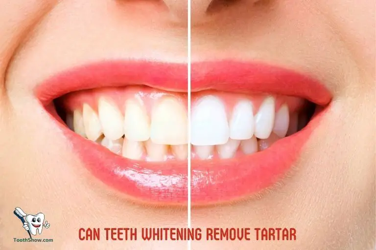 Can Teeth Whitening Remove Tartar