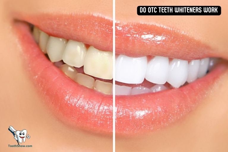 Do Otc Teeth Whiteners Work