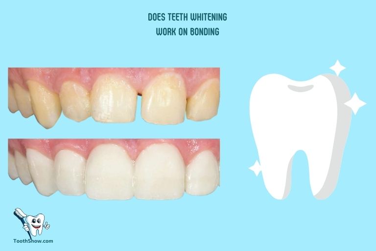 Does Teeth Whitening Work on Bonding