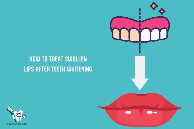 How to Treat Swollen Lips After Teeth Whitening