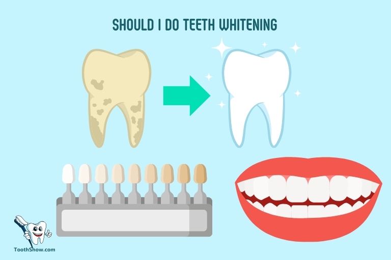 Should I Do Teeth Whitening