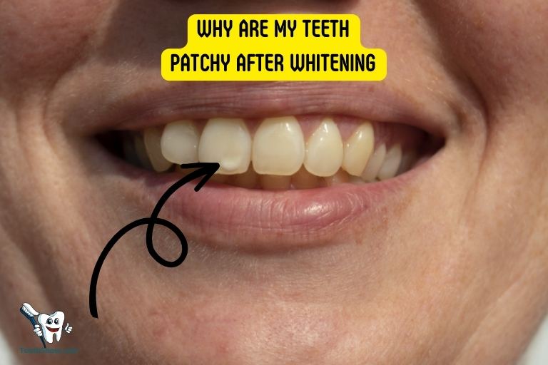 Why Are My Teeth Patchy After Whitening