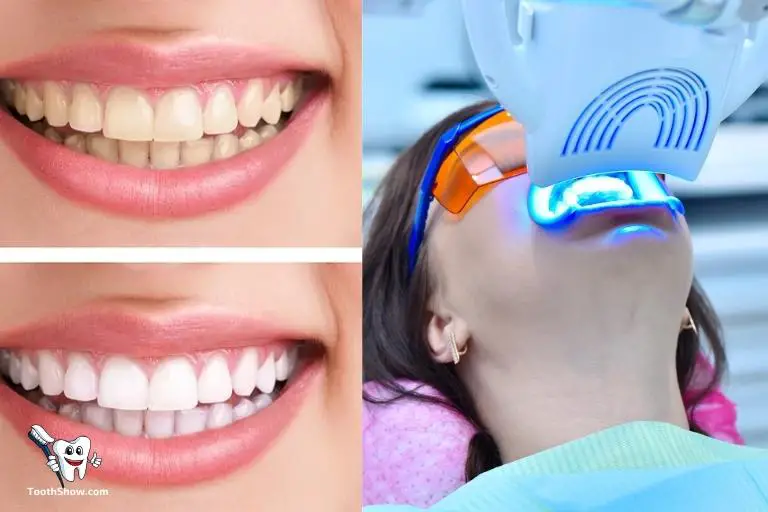 Difference Between Zoom and Laser Teeth Whitening