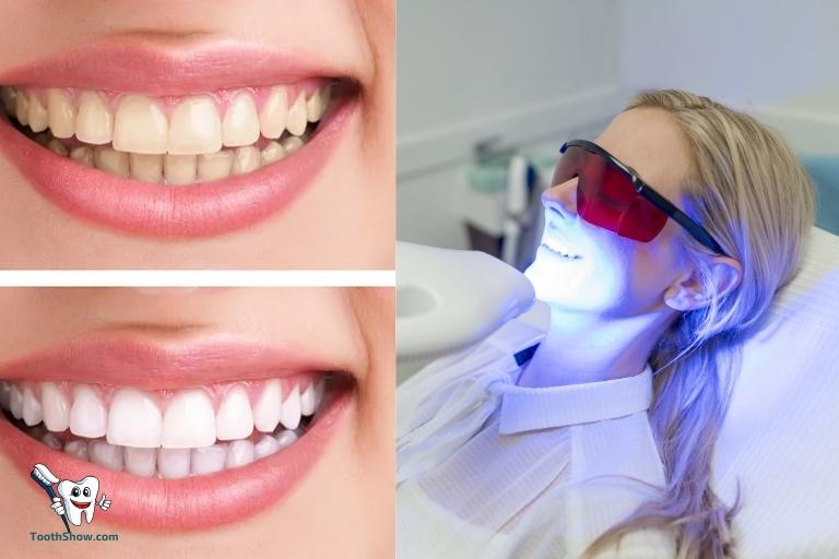Teeth Whitening Zoom Vs Laser