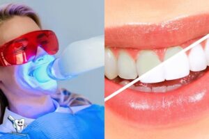 Zoom Teeth Whitening Vs Bleaching: Which One Is Better?