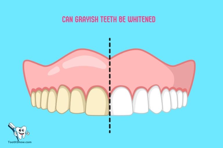 Can Grayish Teeth Be Whitened